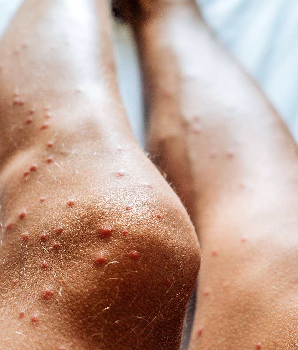 bug bites on a person's legs