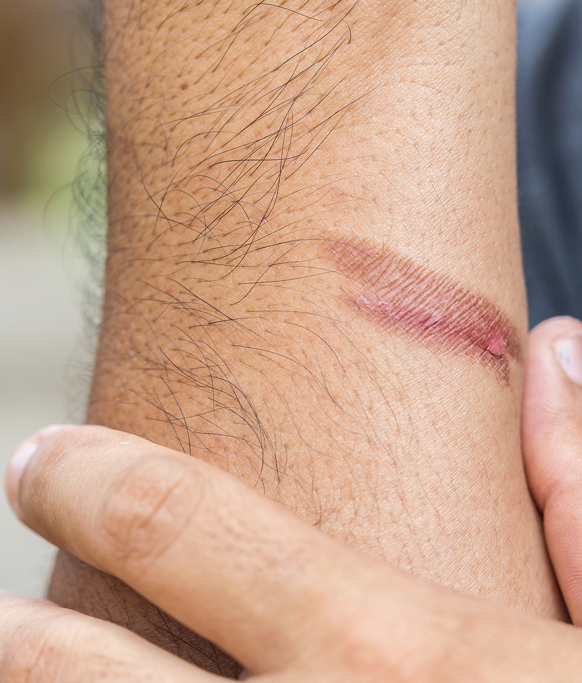 A burn mark on a man's arm