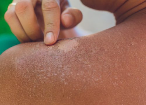 Minor burns on a person's shoulder