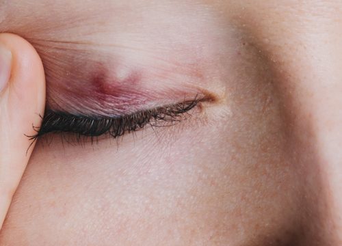 A stye on a woman's eyelid
