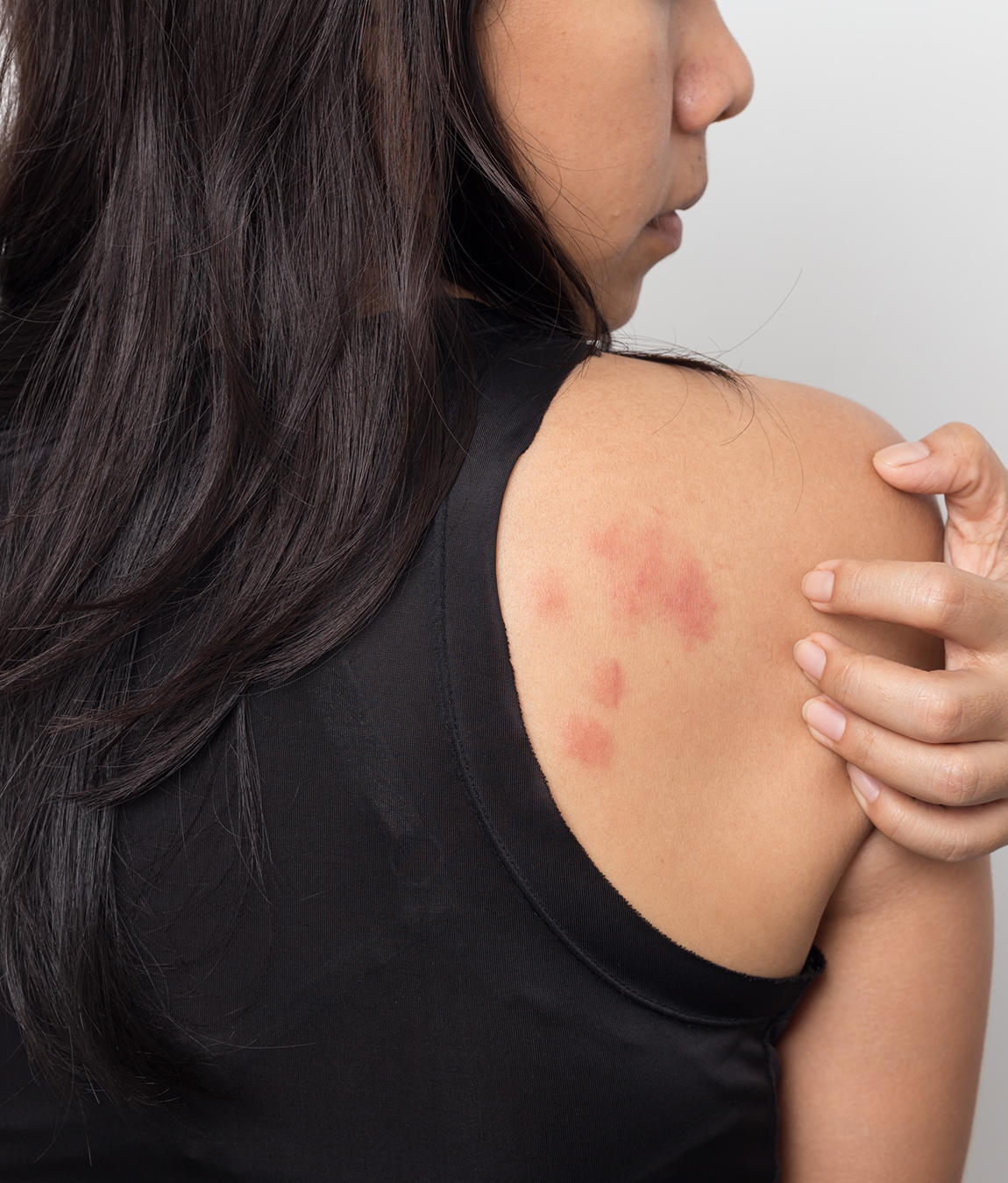 Rashes on a woman's back