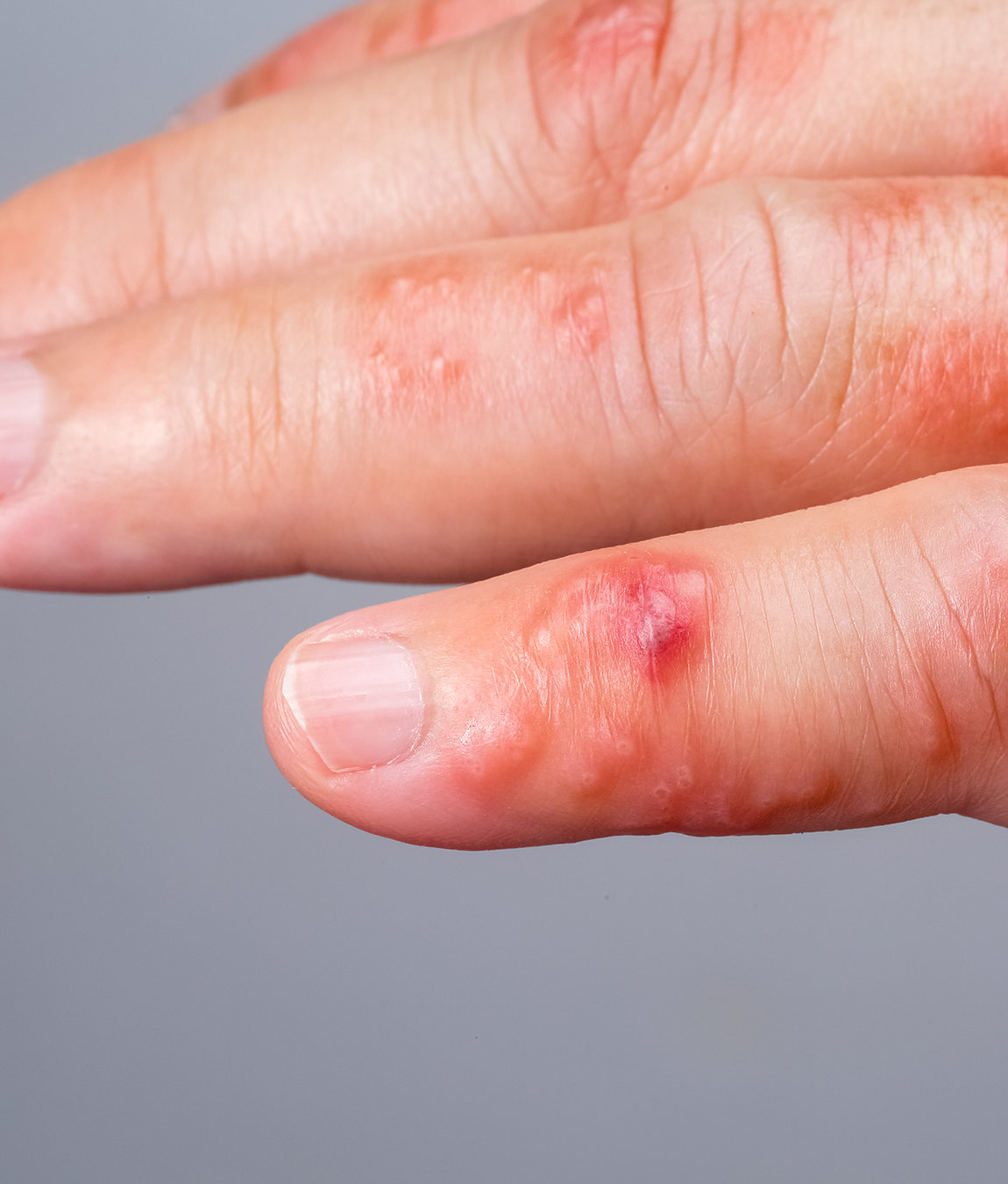 Scabies on a person's fingers