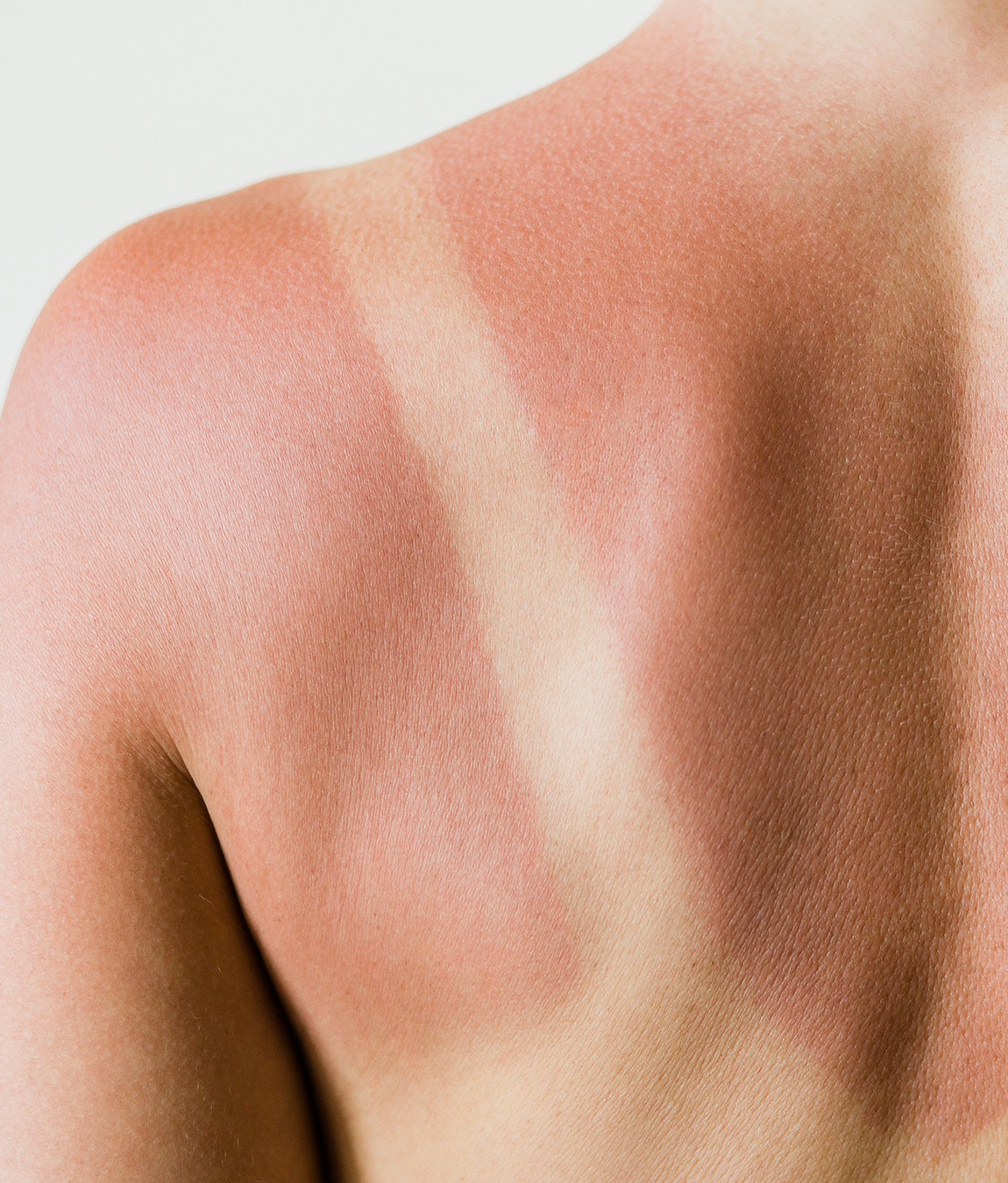 A sunburn on a woman's back