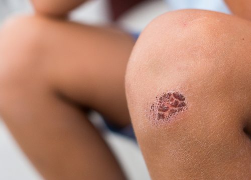 Abrasions on a person's knee