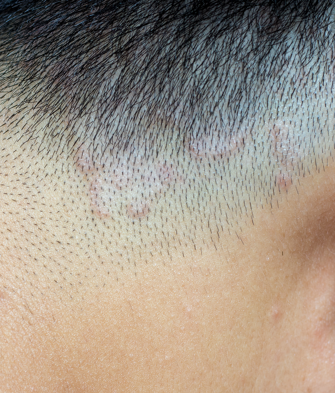 Ringworm on a person's scalp