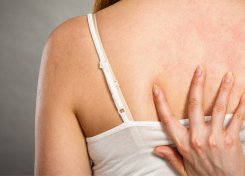 Skin infections on a woman's back